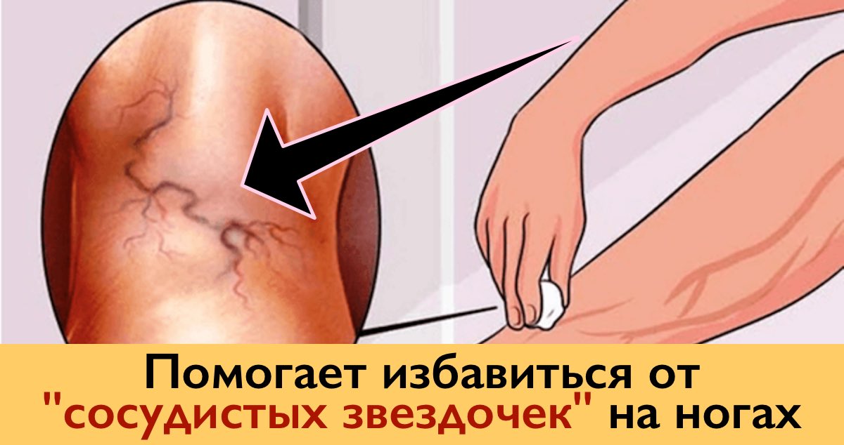 Избавляемся от «СОСУДИСТЫХ ЗВЕЗДОЧЕК» на ногах без операций и лекарств!