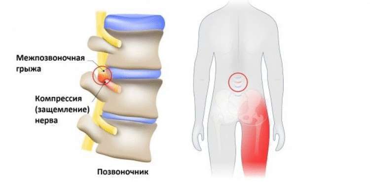 Как распознать защемление седалищного нерва и что с этим делать Как распознать защемление седалищного нерва и что с этим делать