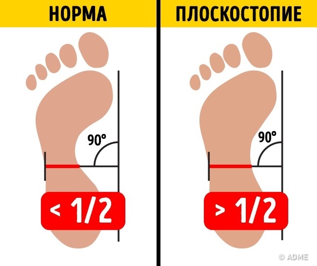 ВСЕГО 2 УПРАЖНЕНИЯ, И ПЛОСКОСТОПИЕ ВАС НЕ ПОБЕСПОКОИТ