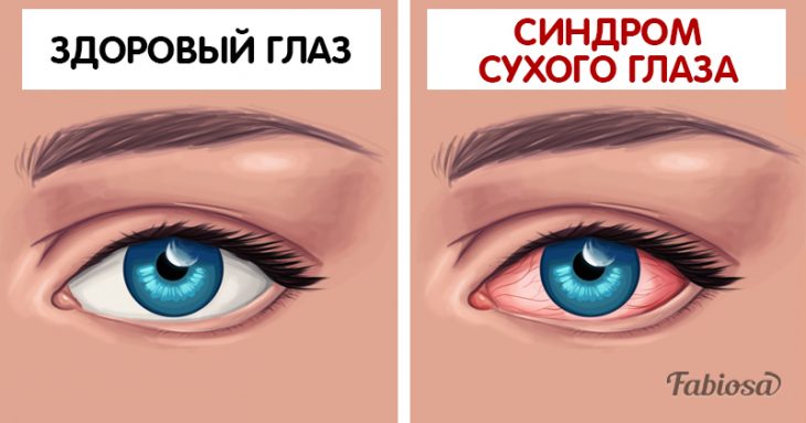 Постоянная сухость глаз — распространённый синдром. Почему ваши глаза сохнут и что с этим делать? Постоянная сухость глаз — распространённый синдром. Почему ваши глаза сохнут и что с этим делать?