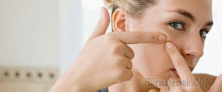 Как избавиться от прыщей акне в домашних условиях?