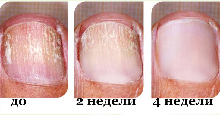 Заметили грибок на ногтях? Действуй немедленно и устрани его быстро! Заметили грибок на ногтях? Действуй немедленно и устрани его быстро!