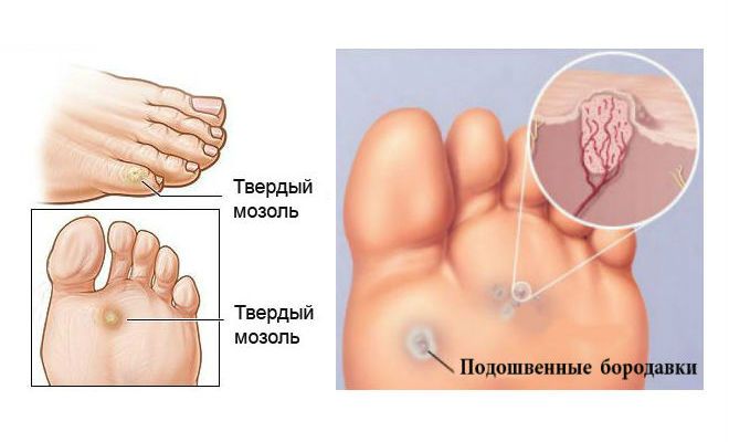 Мозоли и бородавки на ногах: как от них избавиться? лучший способ, который действительно работает Мозоли и бородавки на ногах: как от них избавиться? лучший способ, который действительно работает