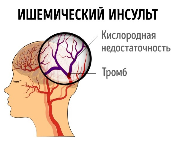 7 СИМПТОМОВ, КОТОРЫЕ ПОМОГУТ РАСПОЗНАТЬ ИНСУЛЬТ У ЖЕНЩИН