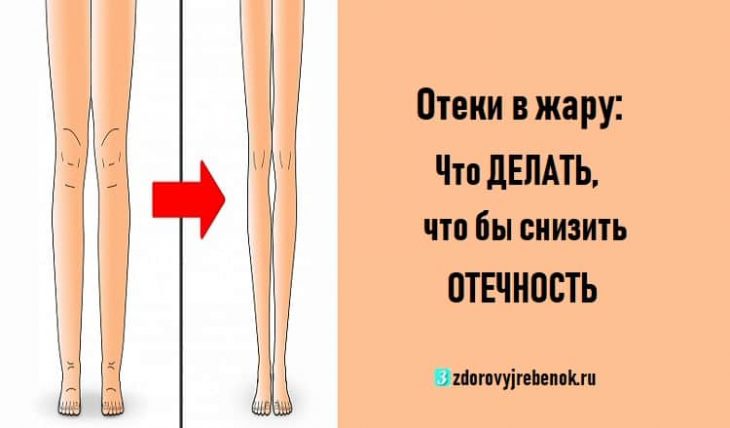 Отеки в жару: Что ДЕЛАТЬ, что бы снизить ОТЕЧНОСТЬ