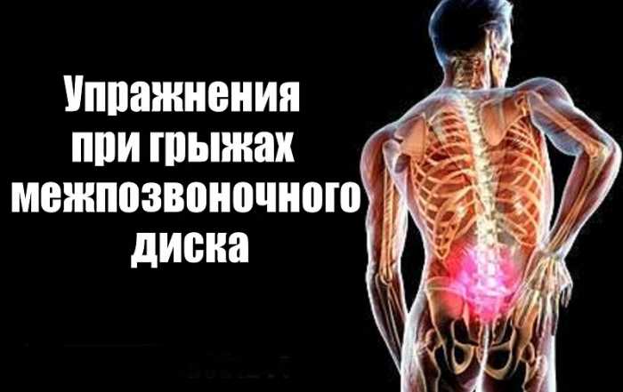 Эффективные упражнения при грыжах и протрузиях позвоночника