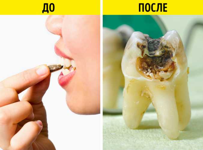 Что происходит с организмом, когда вы часто едите семечки (И правда ли, что они провоцируют аппендицит)