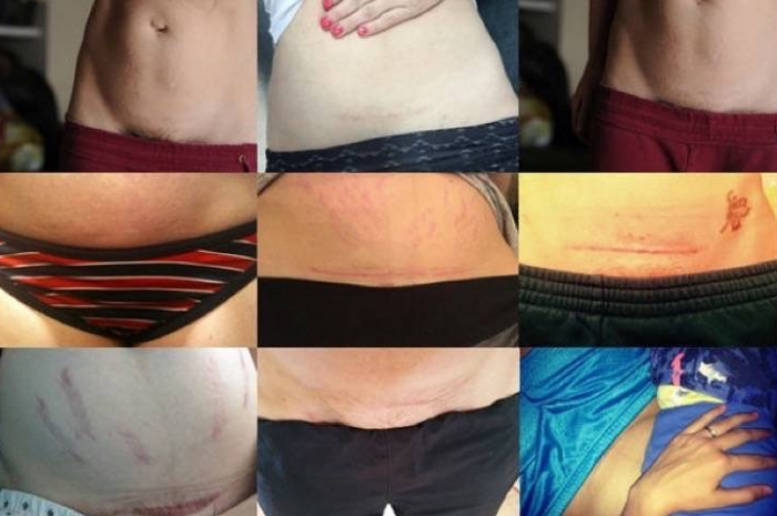 3 вещи которые каждый должен знать о женщинах, которых кесарили