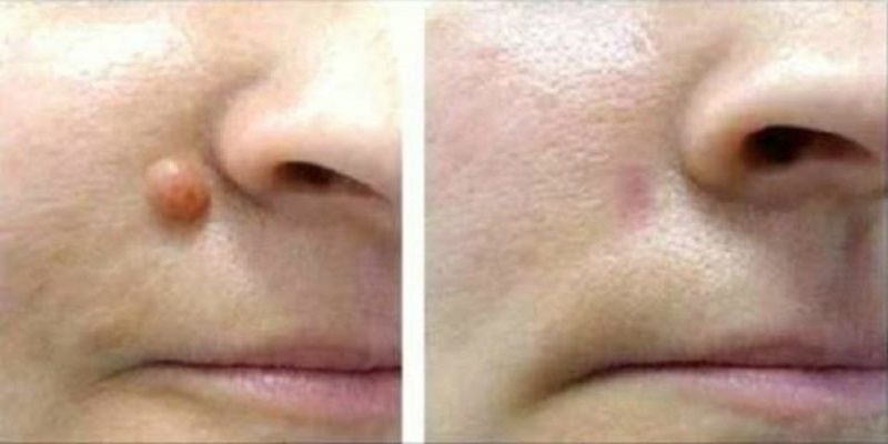 Удивительные способы избавления от уродливых папиллом за одну ночь