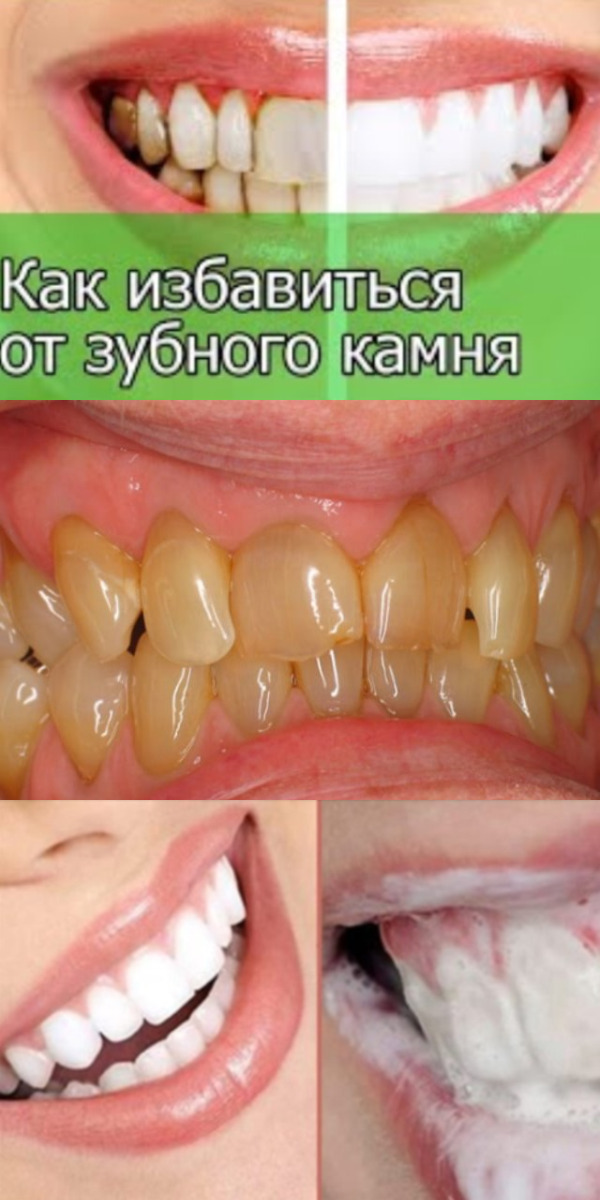 Как избавиться от зубного камня и осветлить пожелтевшую эмаль