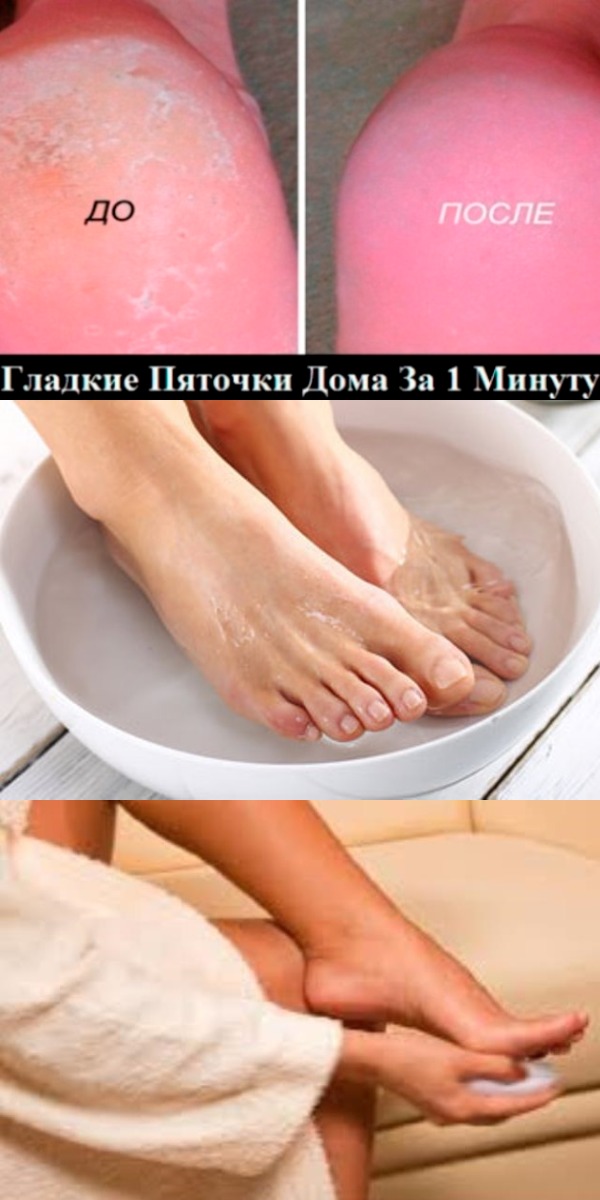 СУПЕР-СРЕДСТВО ДЛЯ ВАШИХ ПЯТОЧЕК. ПОМОГАЕТ ЗА МИНУТУ 