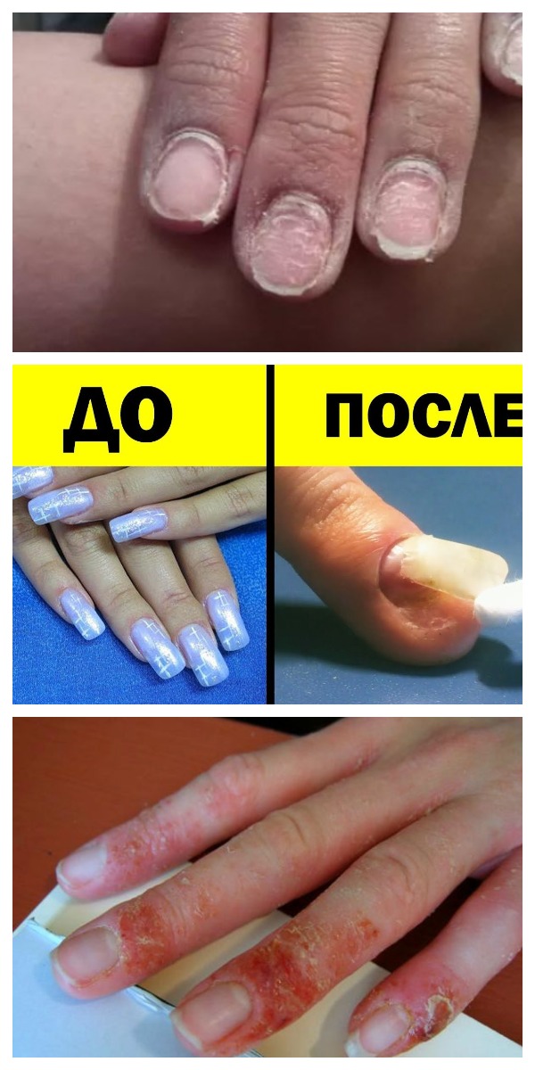 Ужасные последствия применения ГЕЛЬ-ЛАКА! Ужасные последствия применения ГЕЛЬ-ЛАКА!