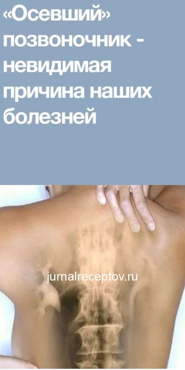«Осевший» позвоночник - невидимая причина наших болезней «Осевший» позвоночник - невидимая причина наших болезней