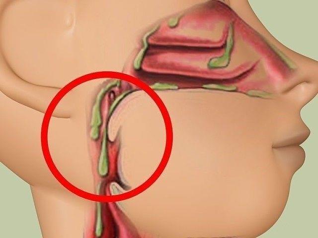 Простые способы избавления от слизи в организме.
