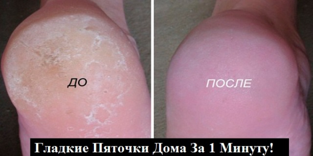 СУПЕР-СРЕДСТВО ДЛЯ ВАШИХ ПЯТОЧЕК. ПОМОГАЕТ ЗА МИНУТУ!