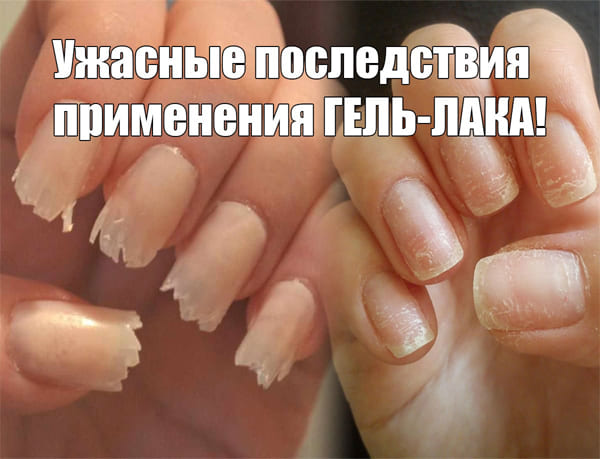 Ужасные последствия применения ГЕЛЬ-ЛАКА! Ужасные последствия применения ГЕЛЬ-ЛАКА!