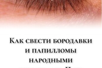 Как свести бородавки и папилломы народными средствами