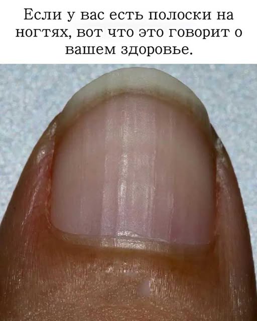 «Что говорят ваши ногти? Вертикальные и горизонтальные полосы, которые нельзя игнорировать!