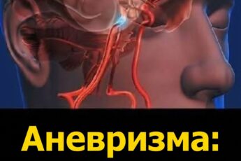 Аневризма: признаки, которые нельзя игнорировать...