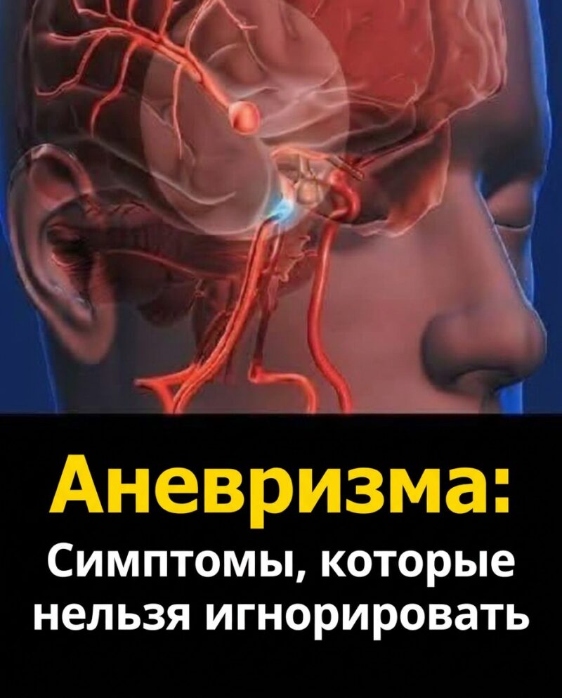 Аневризма: признаки, которые нельзя игнорировать... Аневризма: признаки, которые нельзя игнорировать...