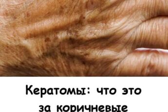 Кератомы: что это за коричневые бляшки на коже и что с ними делать