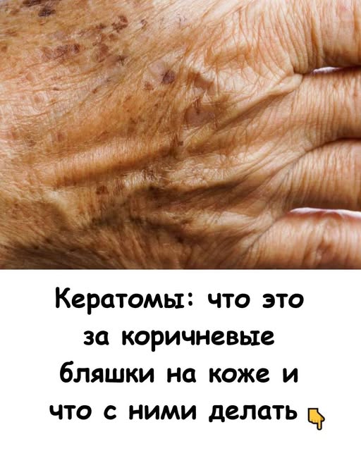Кератомы: что это за коричневые бляшки на коже и что с ними делать Кератомы: что это за коричневые бляшки на коже и что с ними делать